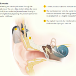 Bone Anchored hearing aids (BAHA) Who? How? Why?